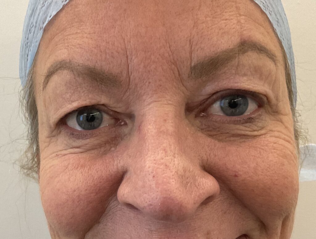 Olivier Amar Cosmetic Surgery London eyelid surgery upper blepharoplasty eye bags before and after