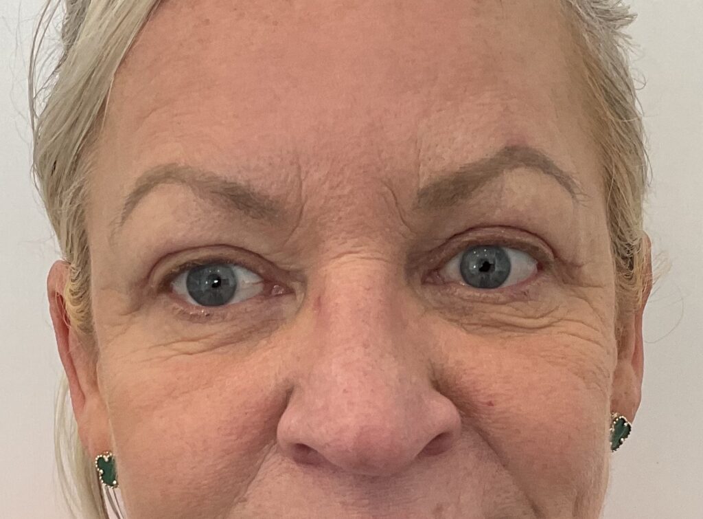Olivier Amar Cosmetic Surgery London eyelid surgery upper blepharoplasty eye bags before and after