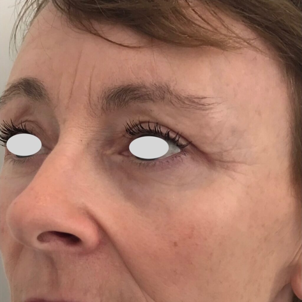 Olivier Amar Cosmetic Surgery London Eyelid surgery blepharoplasty fat transfer autologous before and after
