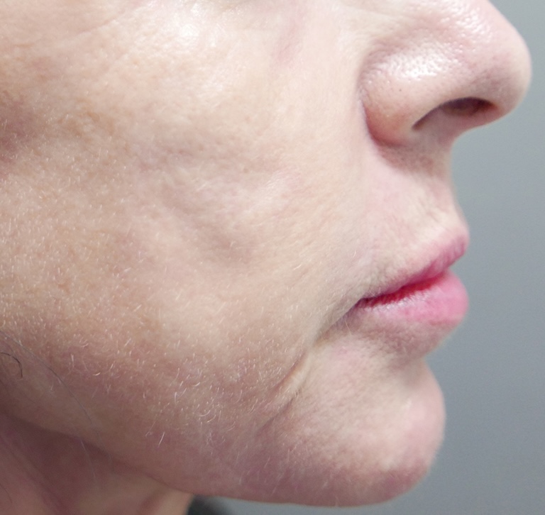 Olivier Amar Cosmetic Surgery London Nano fat transfer skin rejuvenation autologous fat grafting