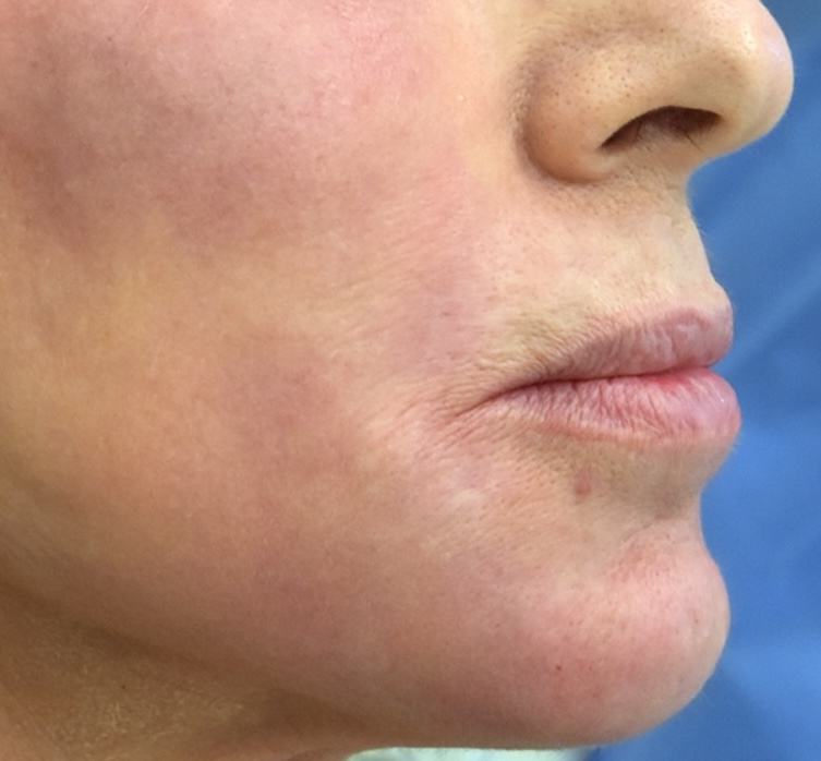 Olivier Amar Cosmetic Surgery London Nano fat transfer skin rejuvenation autologous fat grafting