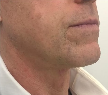 Olivier Amar Cosmetic Surgery London Male Face and Neck Lift, Z Plasty skin excision