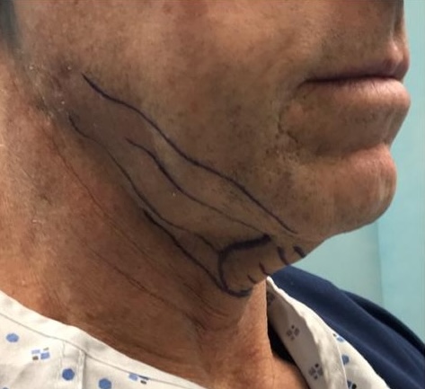 Olivier Amar Cosmetic Surgery London Male Face and Neck Lift, Z Plasty skin excision