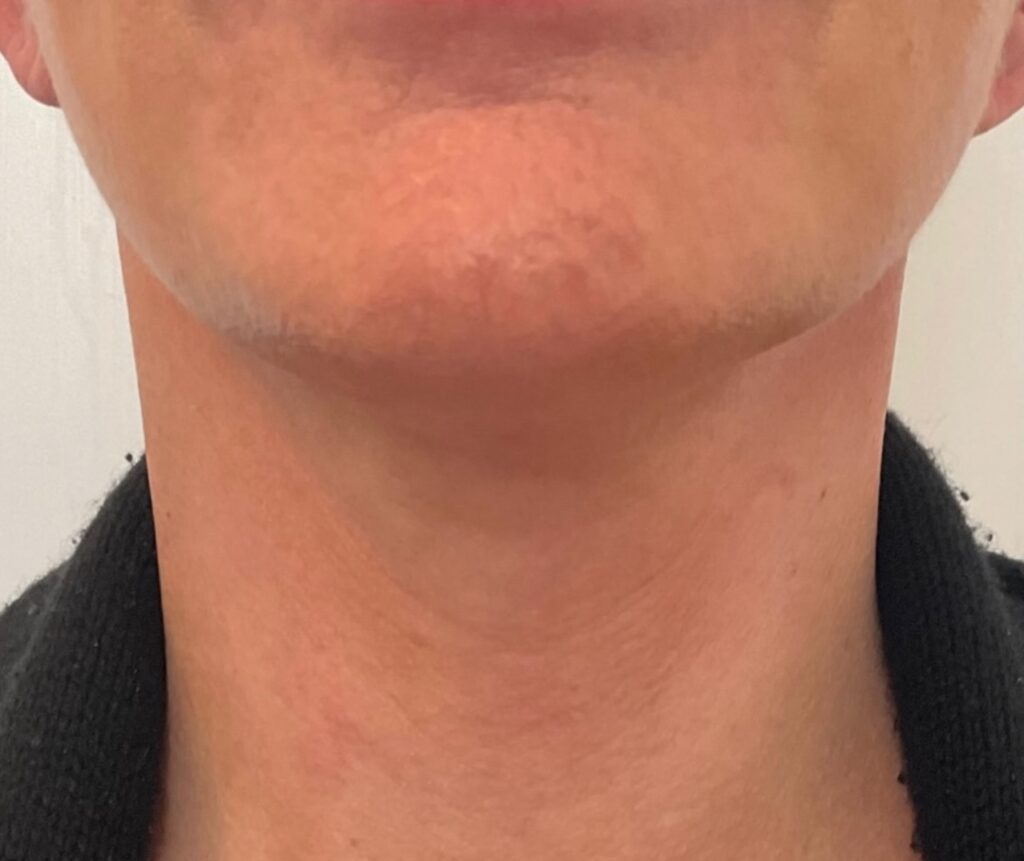 Olivier Amar Cosmetic Surgery London face and neck lift and Renuvion J Plasma skin tightening and liposuction to neck before and after