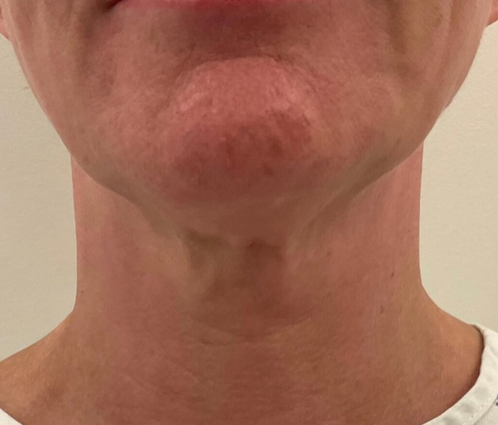 Olivier Amar Cosmetic Surgery London face and neck lift and Renuvion J Plasma skin tightening and liposuction to neck before and after