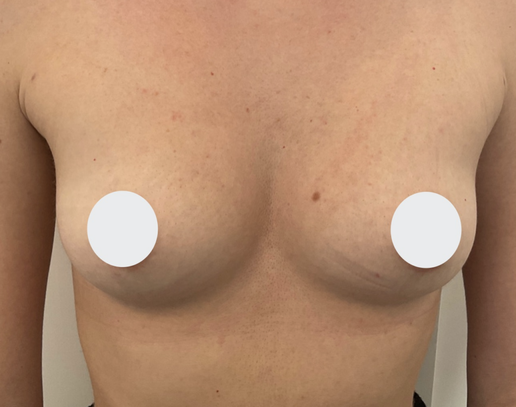 Olivier Amar Cosmetic Surgery London fat transfer breast augmentation before and after