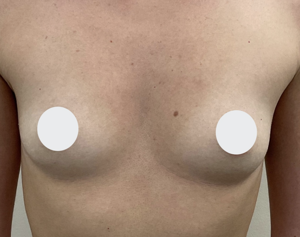 Olivier Amar Cosmetic Surgery London fat transfer breast augmentation before and after