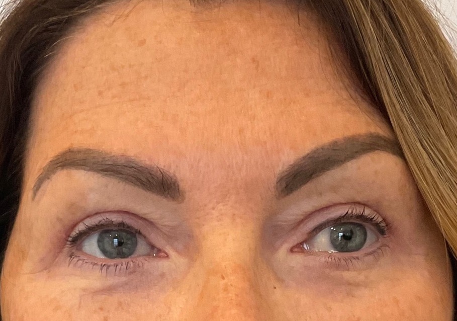 Olivier Amar Cosmetic Surgery London Eyelid surgery blepharoplasty before and after