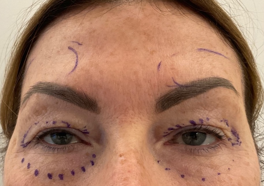 Olivier Amar Cosmetic Surgery London Eyelid surgery blepharoplasty before and after