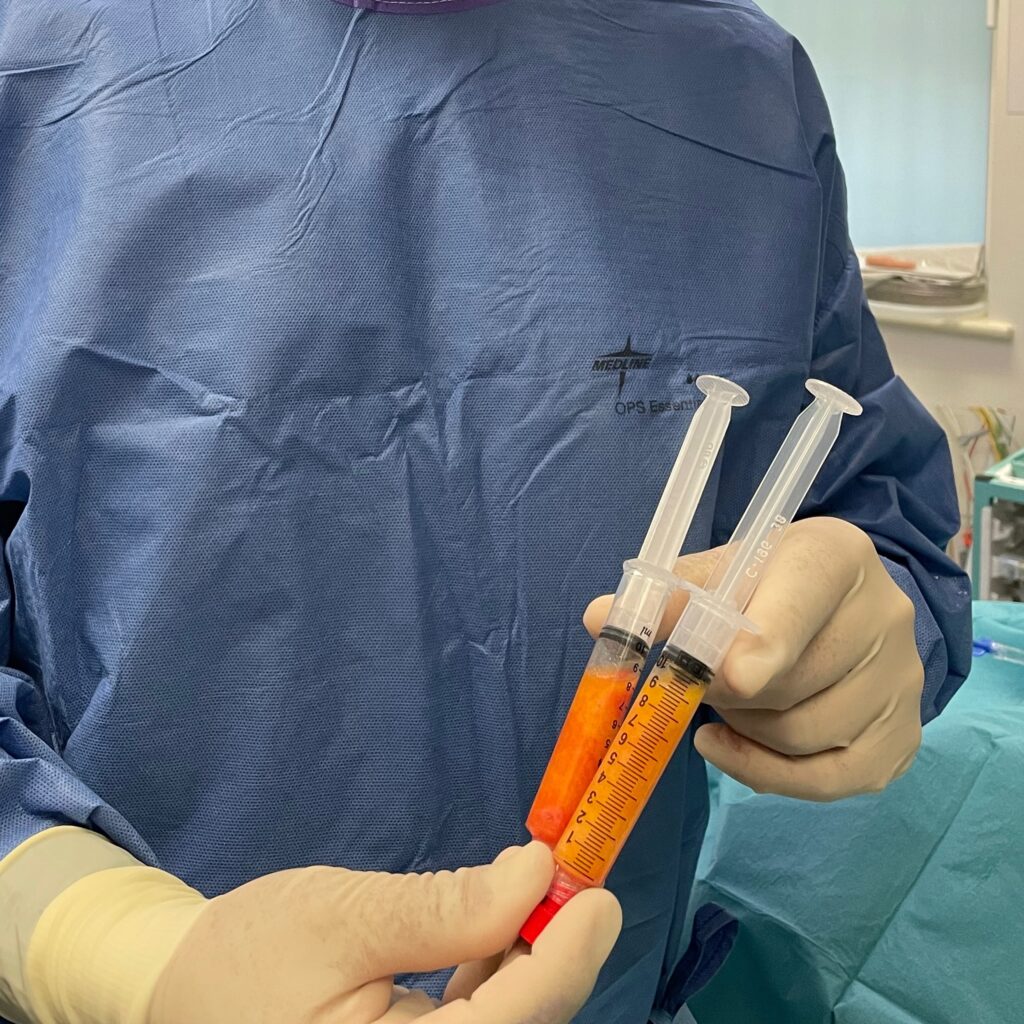 Olivier Amar Cosmetic Surgery London Fat transfer to thighs and buttocks augmentation