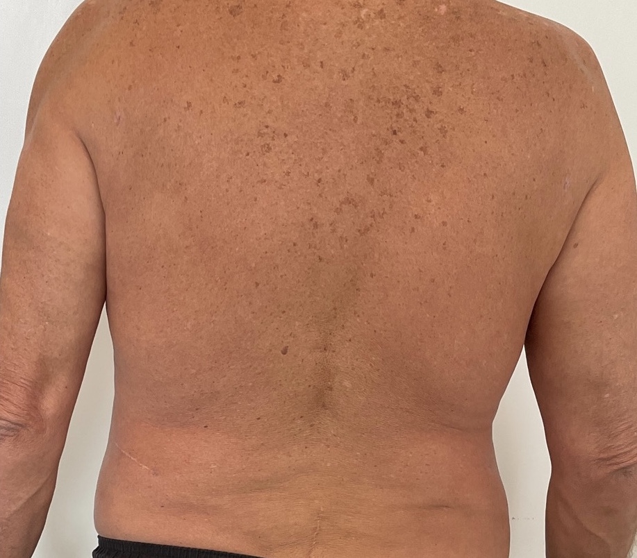 Olivier Amar Cosmetic Surgery London liposuction male body contouring before and after
