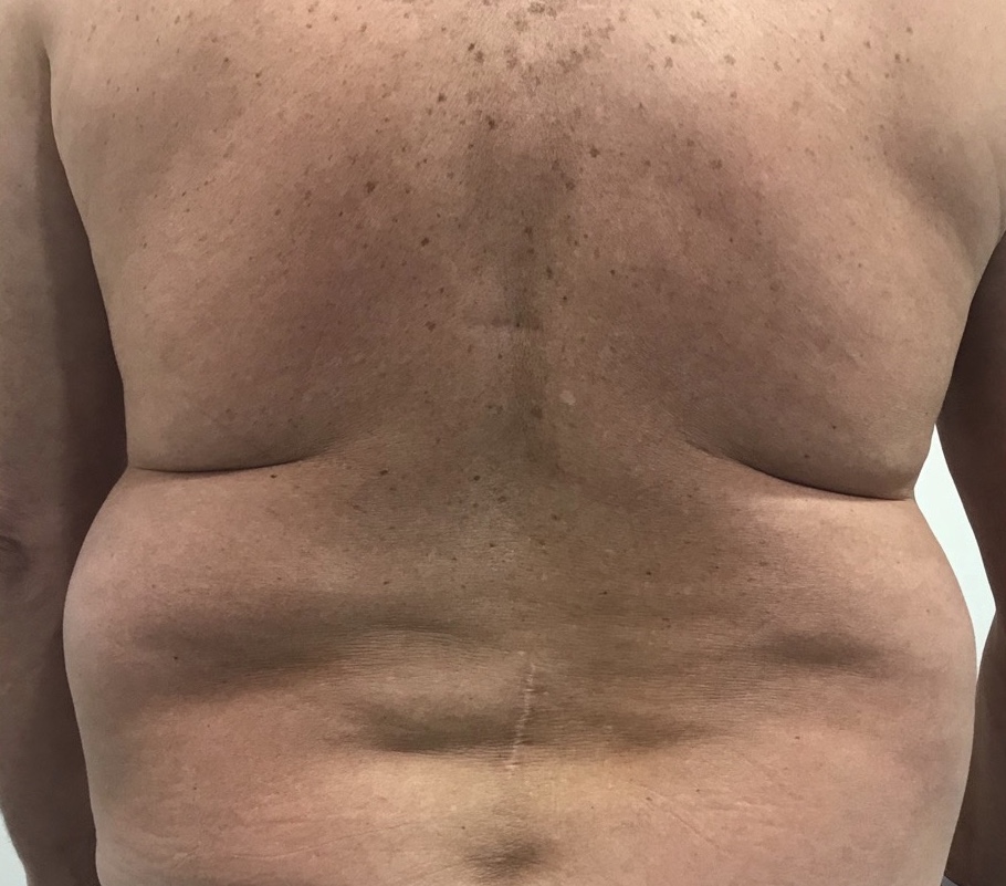 Olivier Amar Cosmetic Surgery London liposuction male body contouring before and after