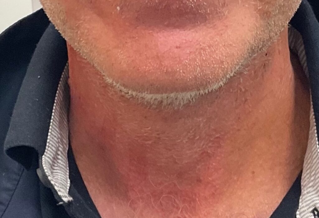 Olivier Amar Cosmetic Surgery London face lift and fat transfer grafting to face before and after
