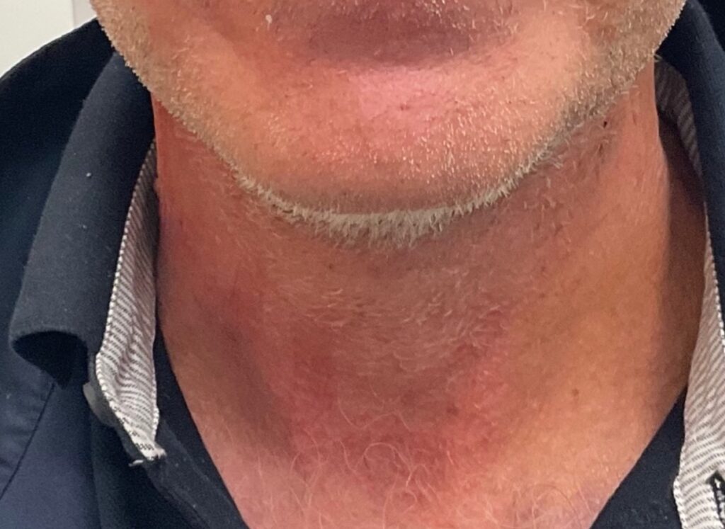 Olivier Amar Cosmetic Surgery London face lift and fat transfer grafting to face before and after