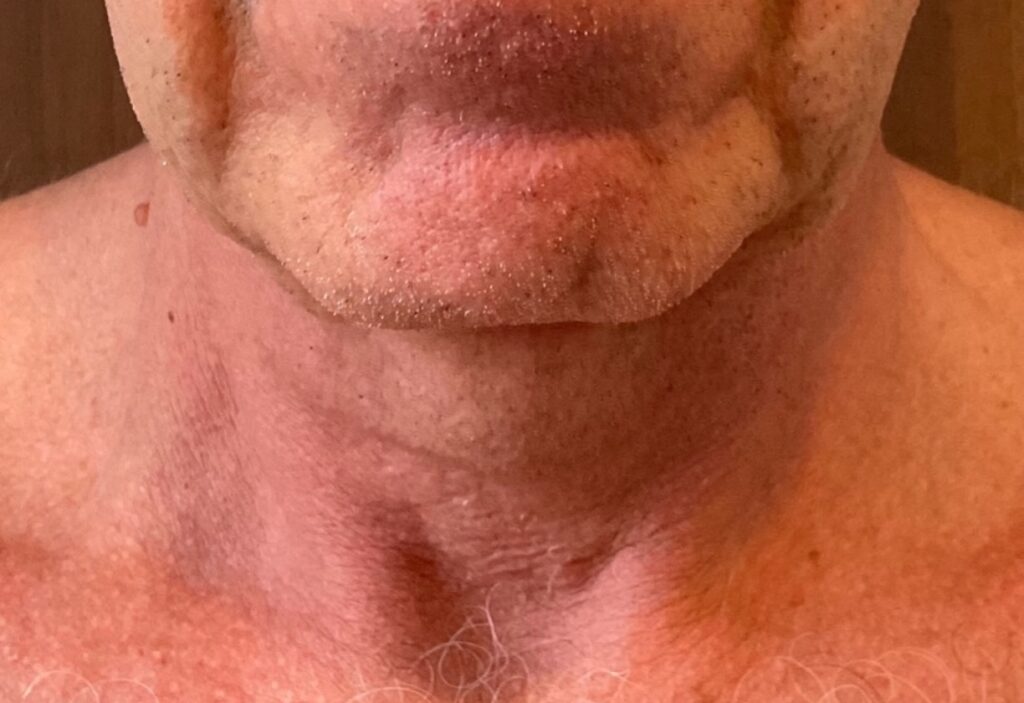 Olivier Amar Cosmetic Surgery London face lift and fat transfer grafting to face before and after