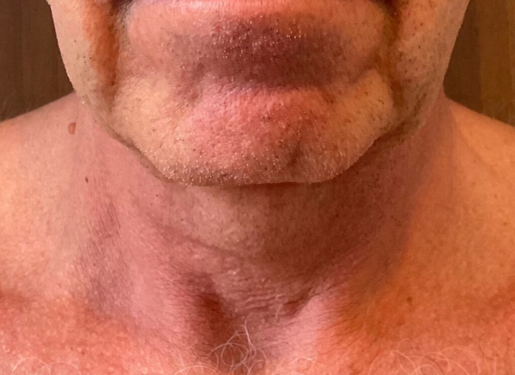 Olivier Amar Cosmetic Surgery London face lift and fat transfer grafting to face before and after