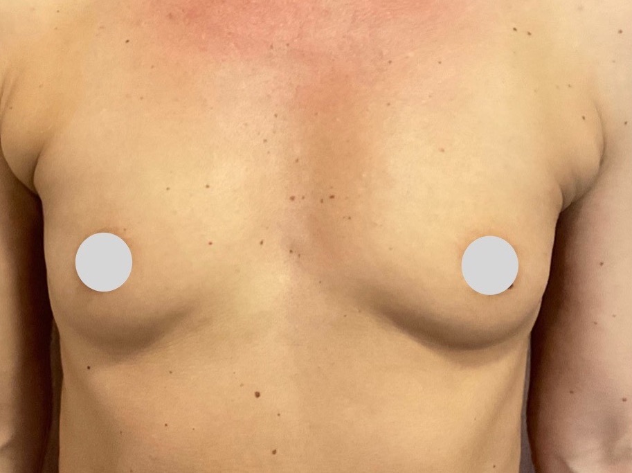 Olivier Amar Cosmetic Surgery London Breast augmentation implants breast enlargement before and after