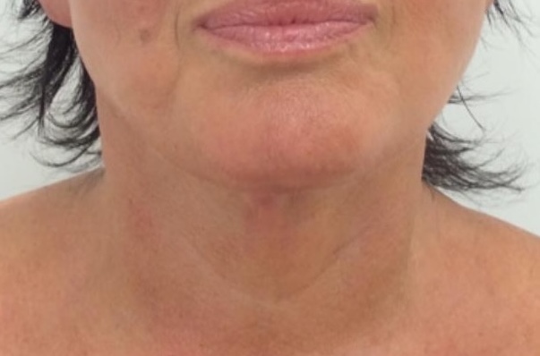 Olivier Amar Cosmetic Surgery London Neck Lift Surgery jaw definition and recontouring