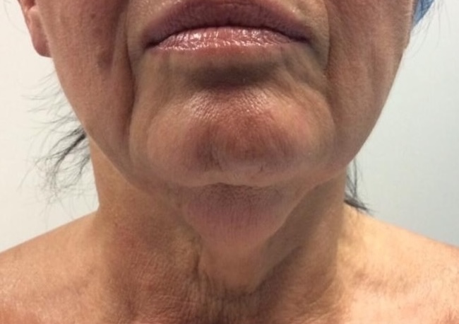 Olivier Amar Cosmetic Surgery London Neck Lift Surgery jaw definition and recontouring