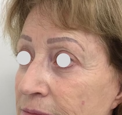 Olivier Amar Cosmetic Surgery London Eyelid surgery fat transfer to face autologous treatment before and after