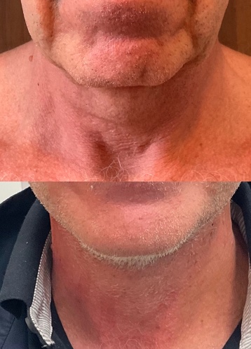 Olivier Amar Cosmetic Surgery London face lift and fat transfer grafting to face before and after