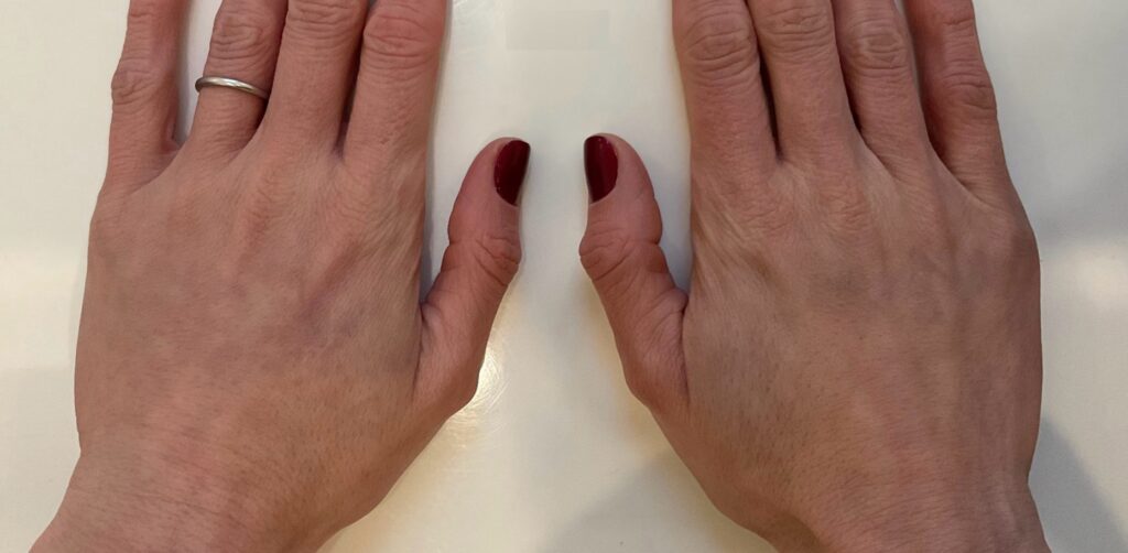 Olivier Amar Cosmetic Surgery London fat transfer grafting hand rejuvenation before and after