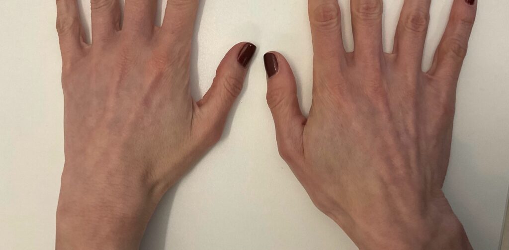 Olivier Amar Cosmetic Surgery London fat transfer grafting hand rejuvenation before and after