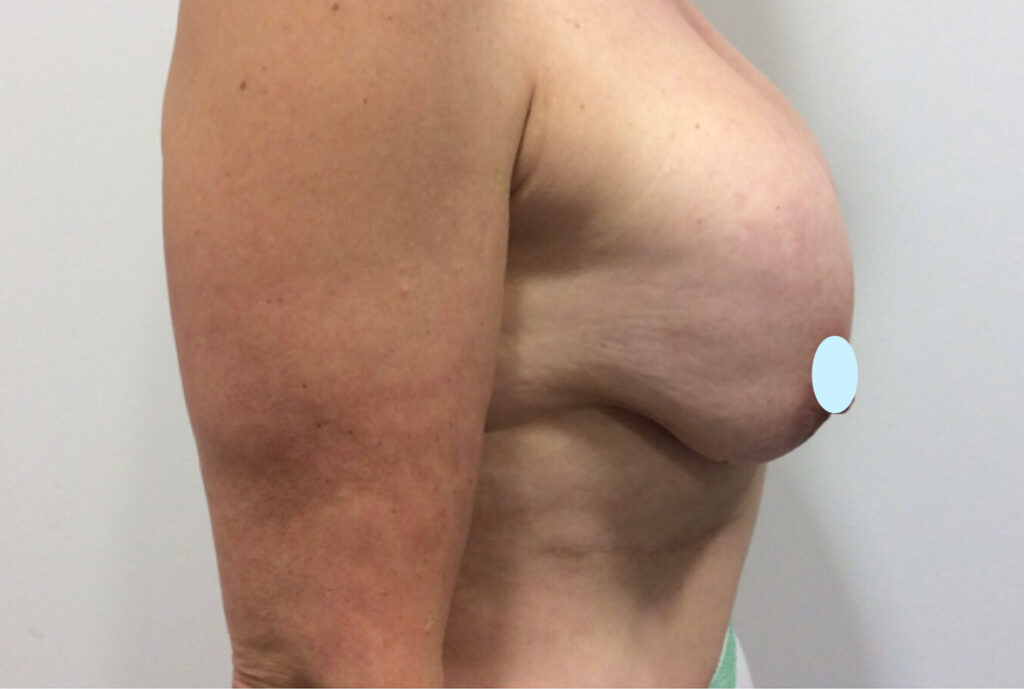 Olivier Amar Cosmetic Surgery London Breast implant removal and replacement reaugmentation before and after