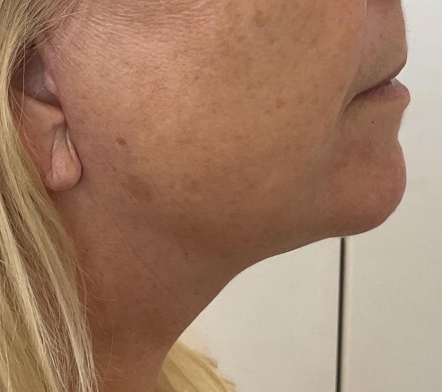 Olivier Amar Cosmetic Surgery London face and neck lift rhytidectomy and fat transfer grafting before and after