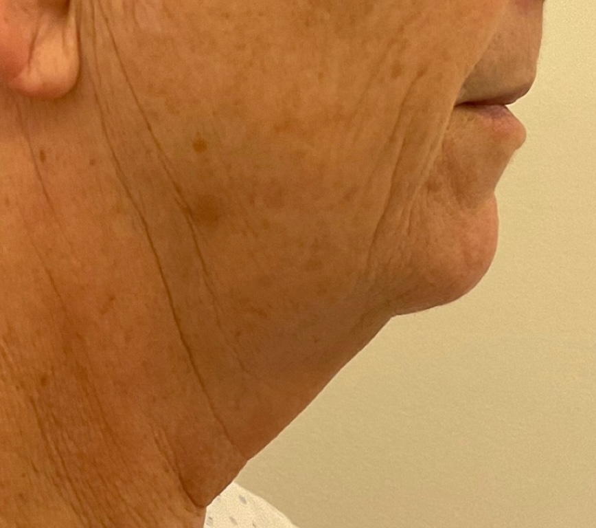 Olivier Amar Cosmetic Surgery London face and neck lift rhytidectomy and fat transfer grafting before and after