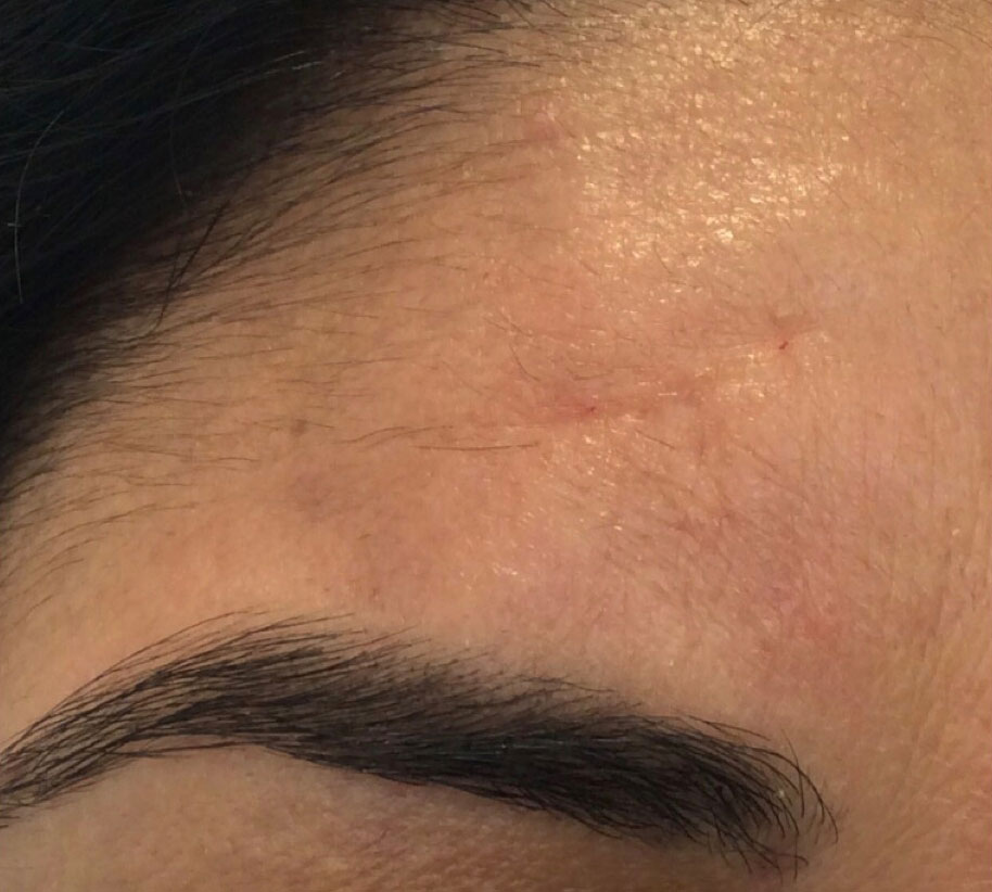Olivier Amar Cosmetic Surgery London Scar improvement