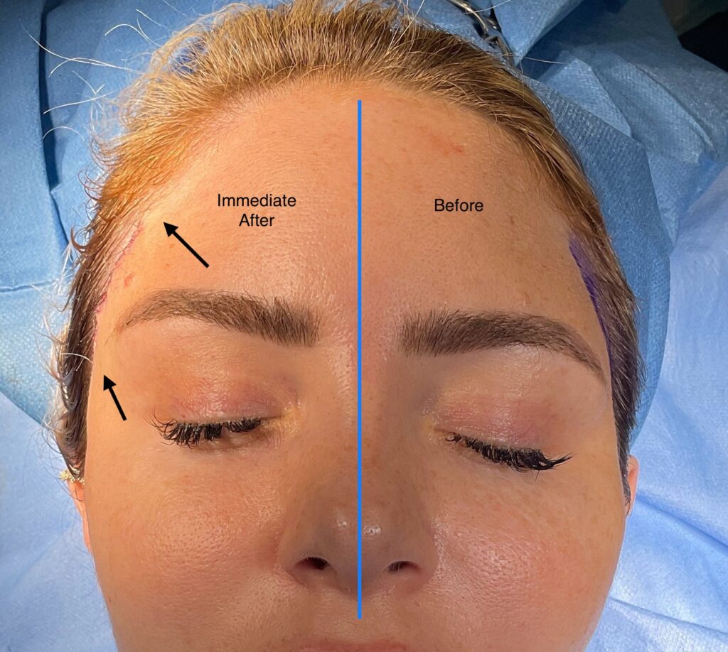 Olivier Amar Cosmetic Surgery London Lateral Temporal Brow Lift before and after