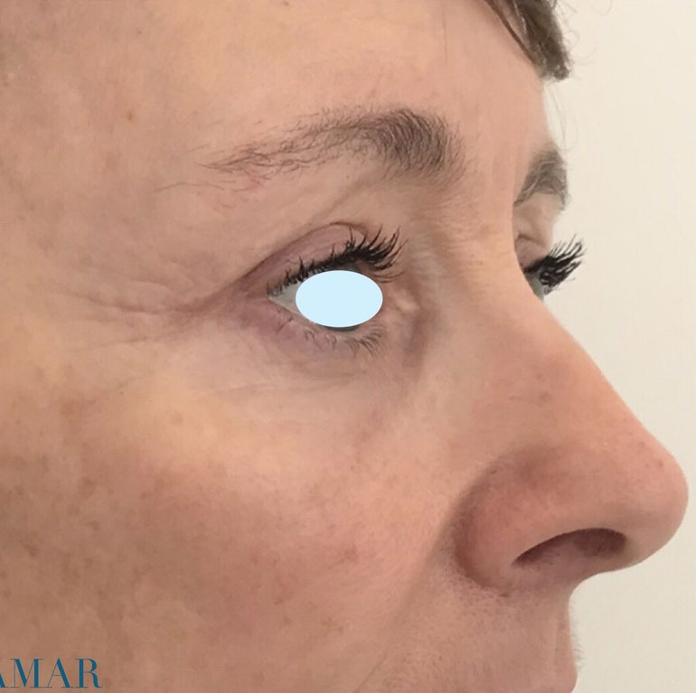 Olivier Amar Cosmetic Surgery London Eyelid surgery Blepharoplasty with fat transfer grafting before and after