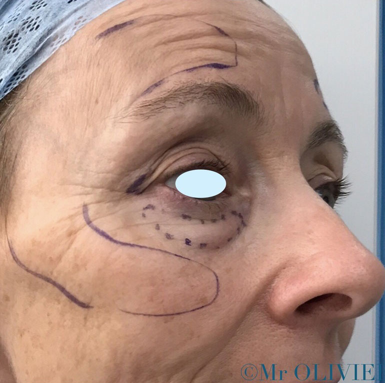 Olivier Amar Cosmetic Surgery London Eyelid surgery Blepharoplasty with fat transfer grafting before and after