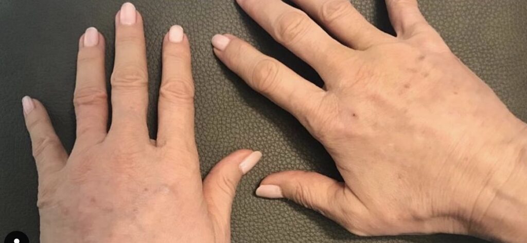 Olivier Amar Cosmetic Surgery London fat transfer grafting hand rejuvenation before and after