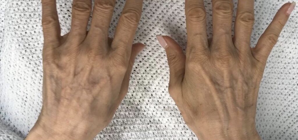 Olivier Amar Cosmetic Surgery London fat transfer grafting hand rejuvenation before and after