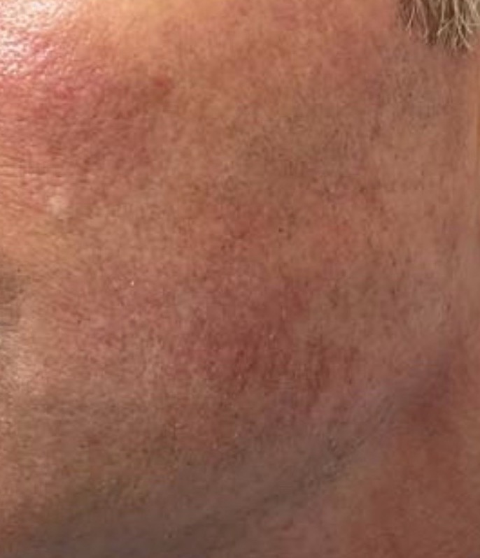 Olivier Amar Cosmetic Surgery London Aerolase Neo Skin Rejuvenation rosacea and redness before and after