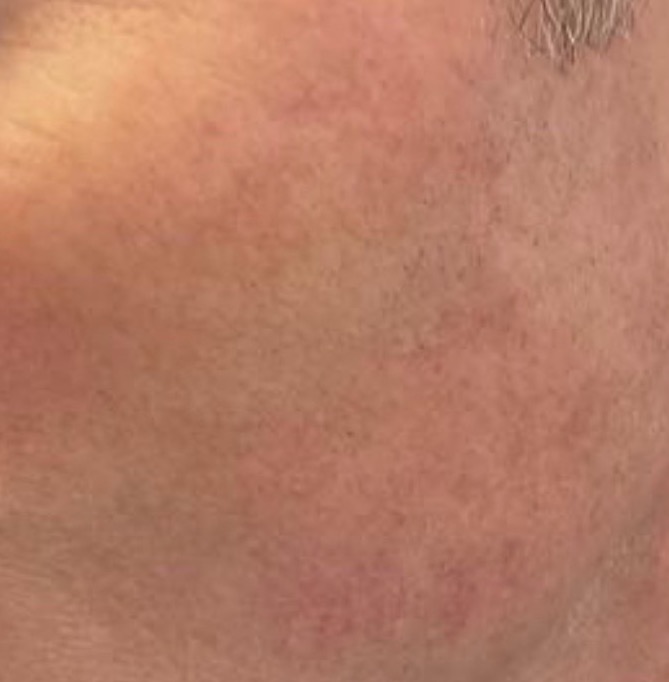 Olivier Amar Cosmetic Surgery London Aerolase Neo Skin Rejuvenation rosacea and redness before and after