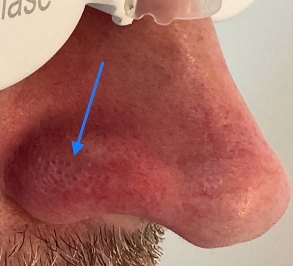 Olivier Amar Cosmetic Surgery London Aerolase Neo Skin Rejuvenation spider veins before and after