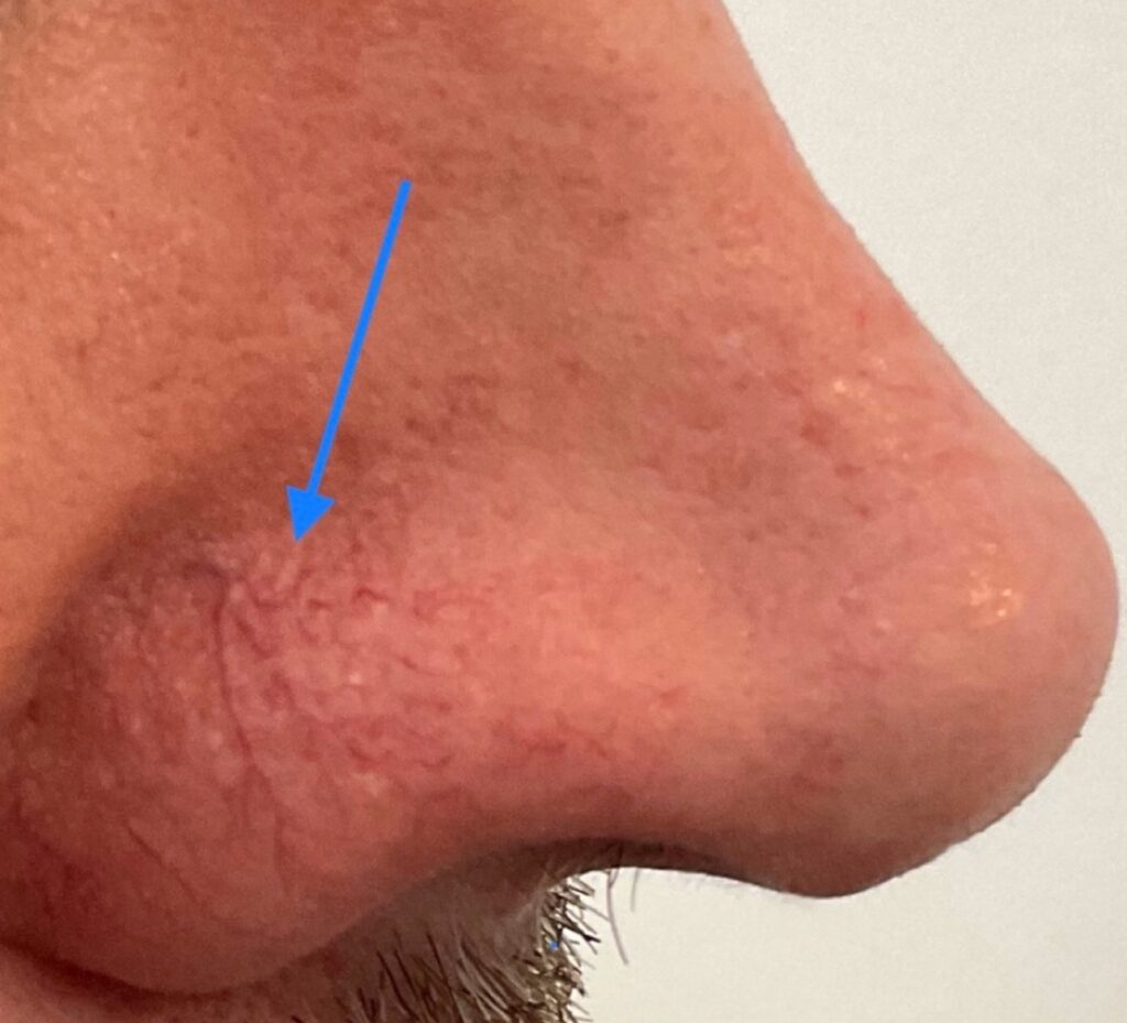 Olivier Amar Cosmetic Surgery London Aerolase Neo Skin Rejuvenation spider veins before and after