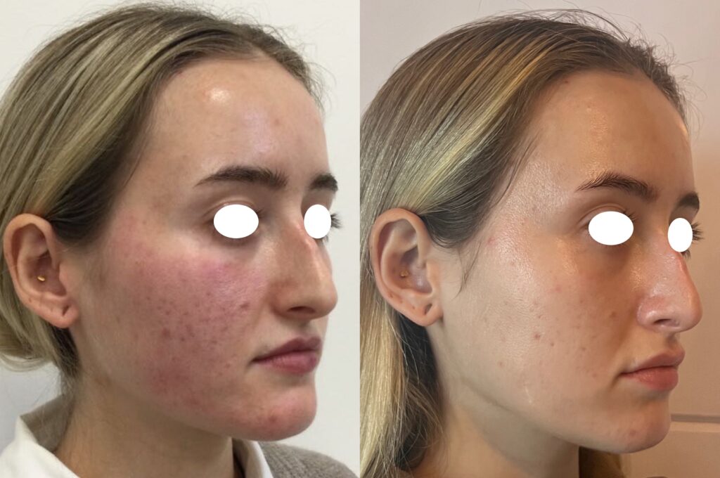 Olivier Amar Cosmetic Surgery London Aerolase Neo Laser Acne before and after
