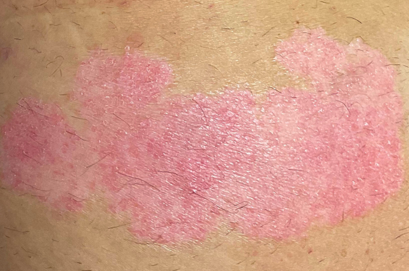 Olivier Amar Cosmetic Surgery London Aerolase Neo Skin Rejuvenation psoriasis skin texture before and after