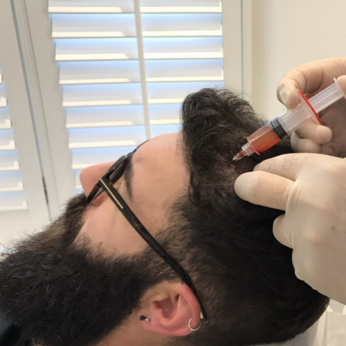 PRP Hair Restoration Treatment
