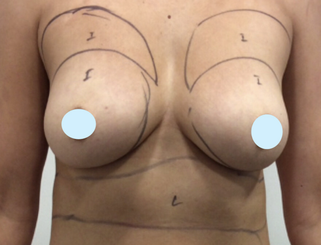 Olivier Amar Cosmetic Surgery London fat transfer breast augmentation before and after