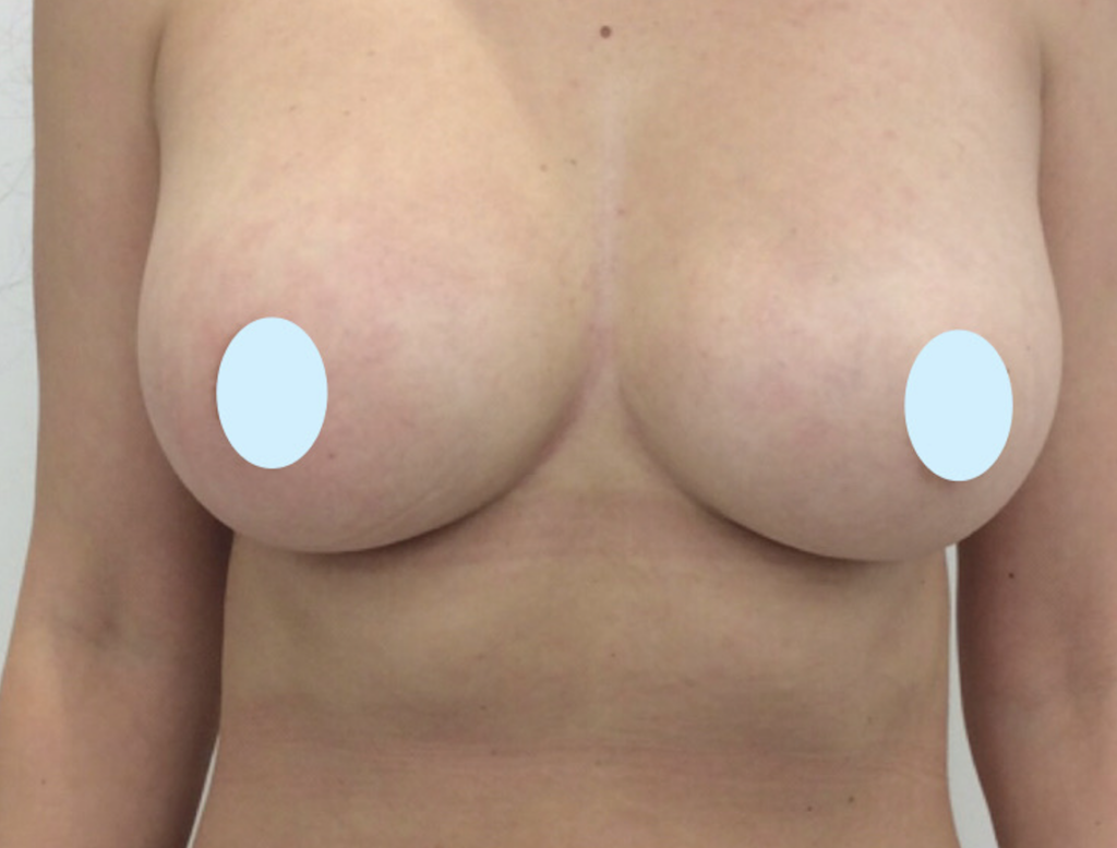Olivier Amar Cosmetic Surgery London fat transfer breast augmentation before and after
