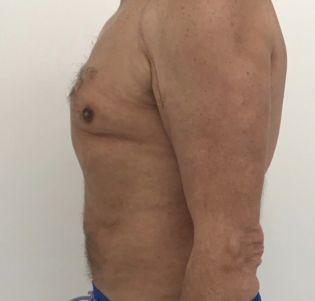 Olivier Amar male liposuction abdoment