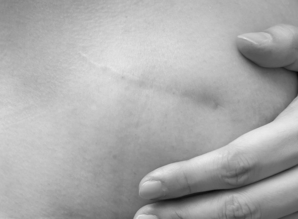 Olivier Amar Cosmetic Surgery London scar improvement