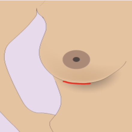 Olivier Amar Cosmetic Surgery London breast augmentation with implants enlargement scars