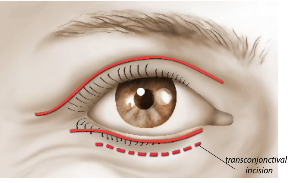 Olivier Amar Cosmetic Surgery London eyelid surgery blepharoplasty scars