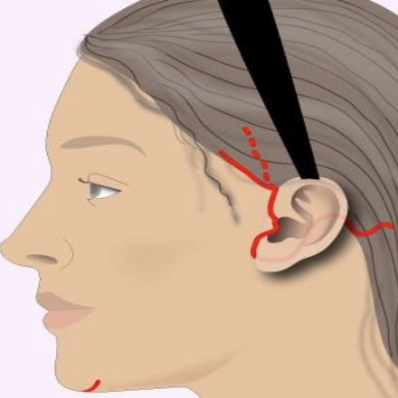 Olivier Amar Cosmetic Surgery London face and neck lift scars